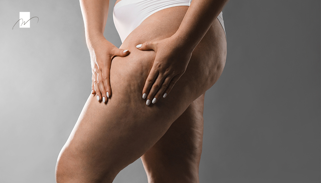 cellulite
