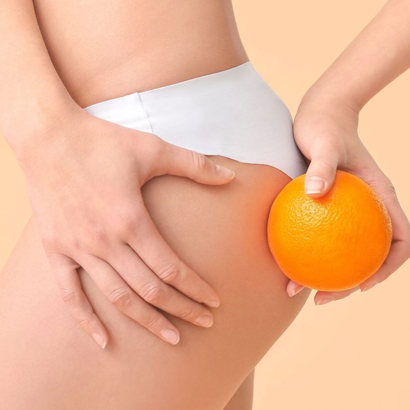 cellulite
